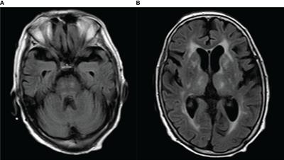 Case report: Shingles-associated probable Bickerstaff brainstem encephalitis with IgM anti-sulfatide positivity